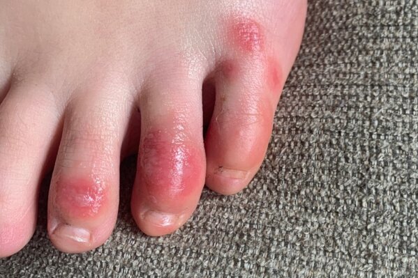 Toes swollen and hot sale itchy